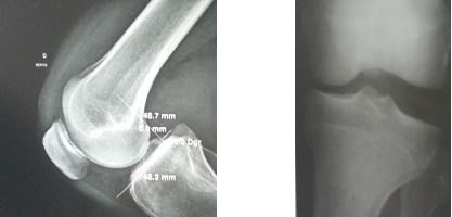 GENOU - Rupture du ligament croisé postérieur (LCP) | Docteur ...