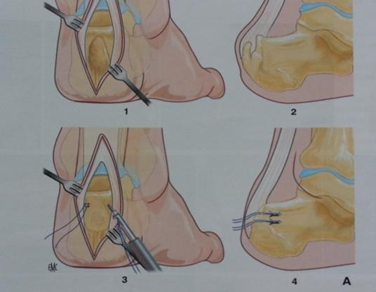 CHEVILLE et PIED - Lésions du tendon d'Achille | Docteur Franck ...